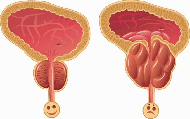 Prostat büyümesi